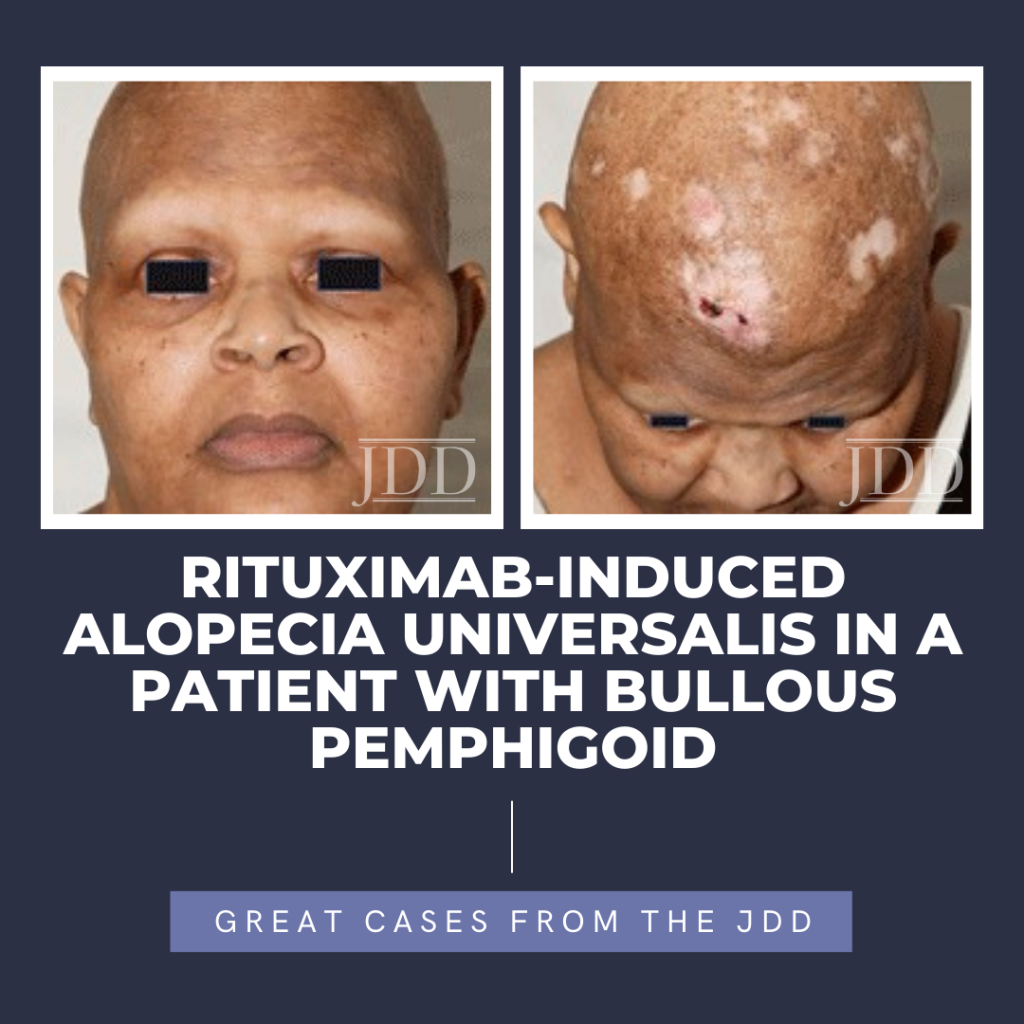 RituximabInduced Alopecia Universalis in a Patient With Bullous