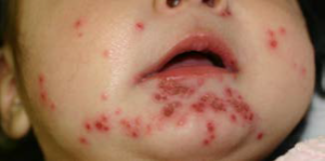 Pediatric Dermatology Case