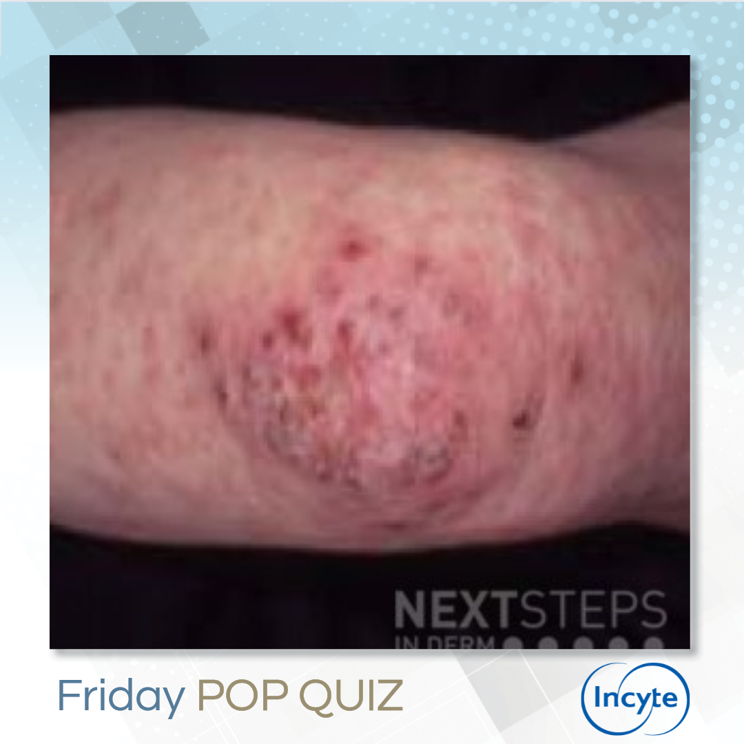 Friday Pop Quiz #223 - Next Steps in Dermatology