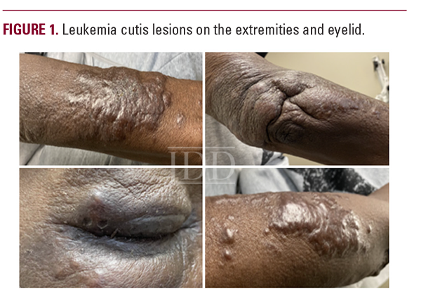 Leukemia Cutis