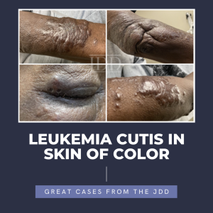 leukemia cutis
