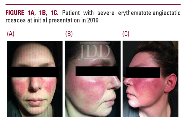 rosacea