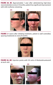rosacea
