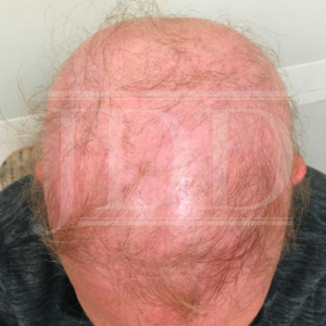 alopecia areata