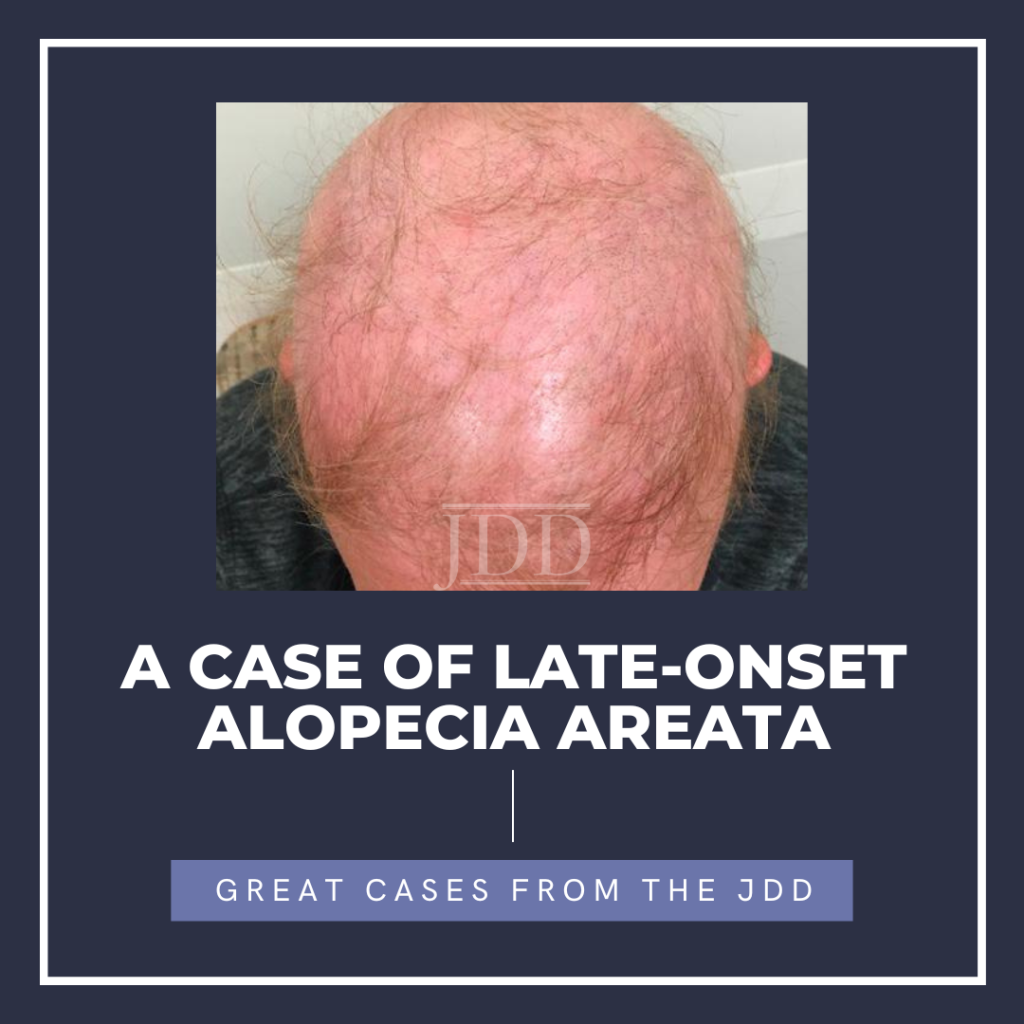 A Case Of Late Onset Alopecia Areata Next Steps In Dermatology a-case-of-late-onset-alopecia-areata-next-steps-in-dermatology