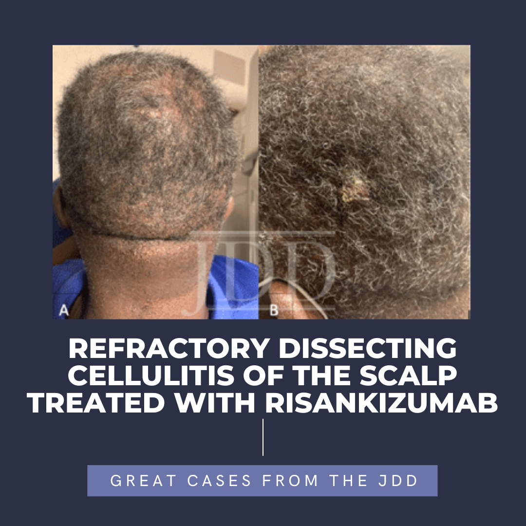 Perifolliculitis Capitis Abscedens Et Suffodiens Archives Next Steps Perifolliculitis Capitis Abscedens Et Suffodiens Archives Next Steps
