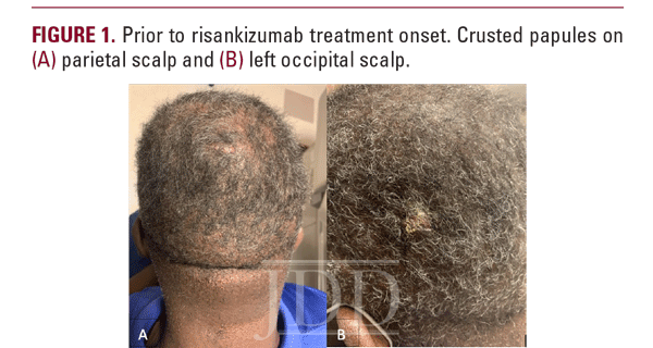 dissecting cellulitis 