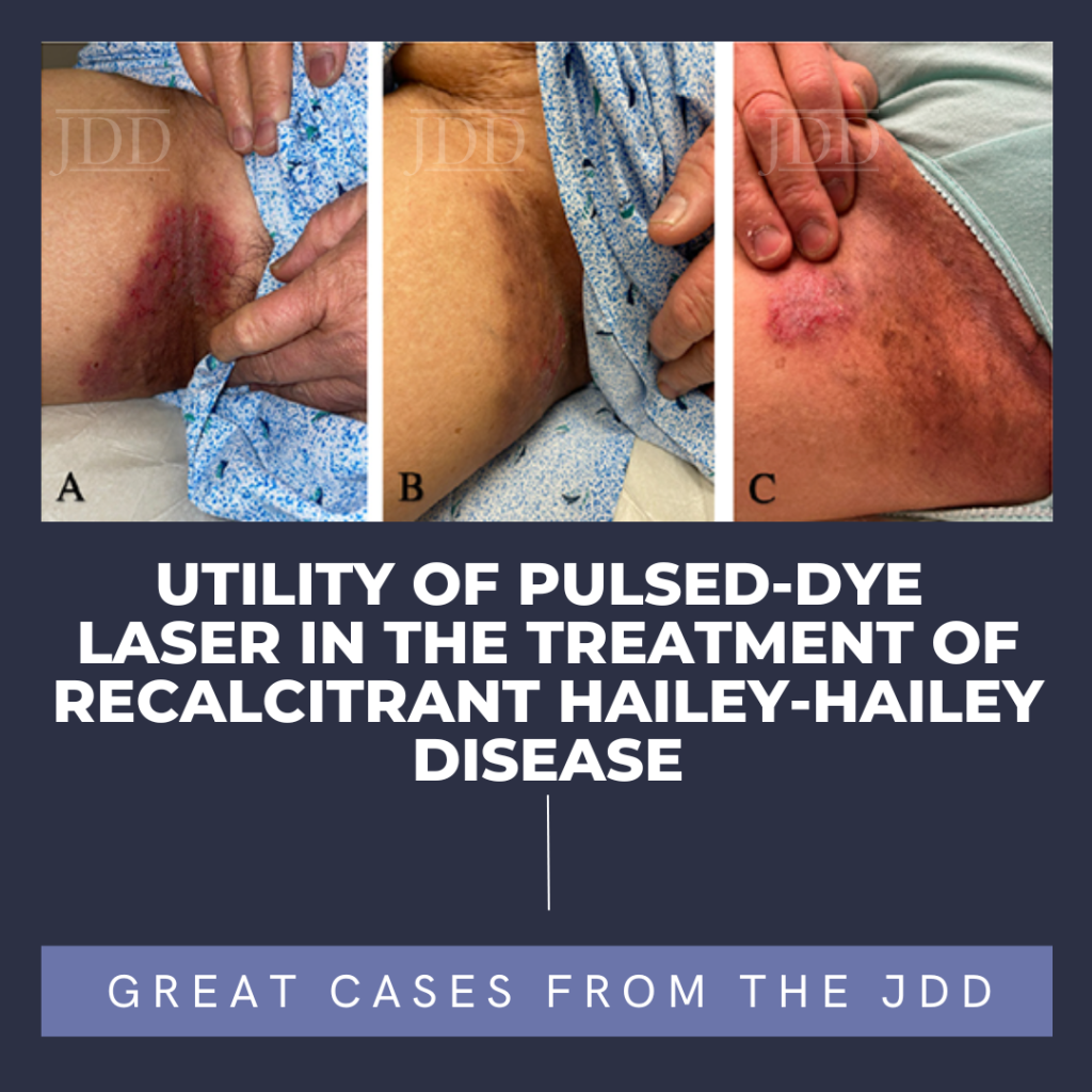 Hailey-Hailey Disease