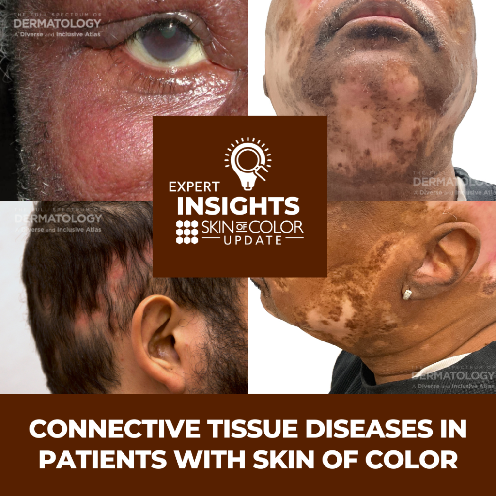 Connective Tissue Diseases in Patients With Skin of Color Expert