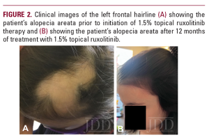 pediatric alopecia areata