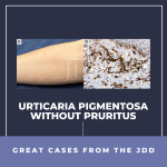 urticaria pigmentosa