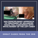 basal cell carcinoma