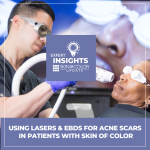 acne scars