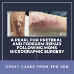 wound closure