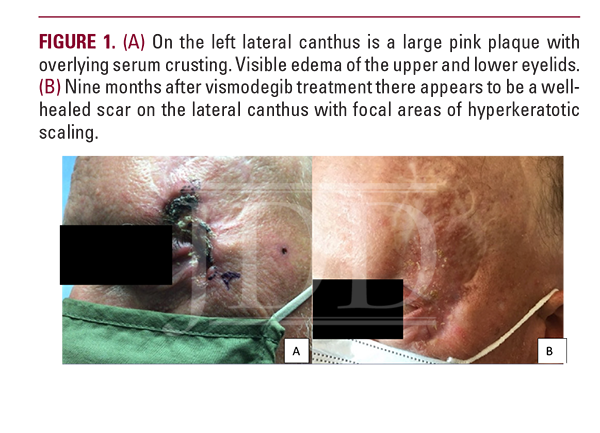 Basal Cell Carcinoma