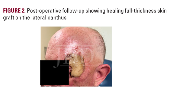 Basal Cell Carcinoma