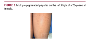 Syringoma