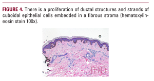 Syringoma