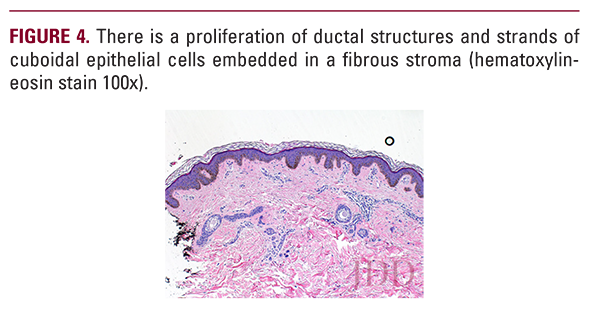 Syringoma