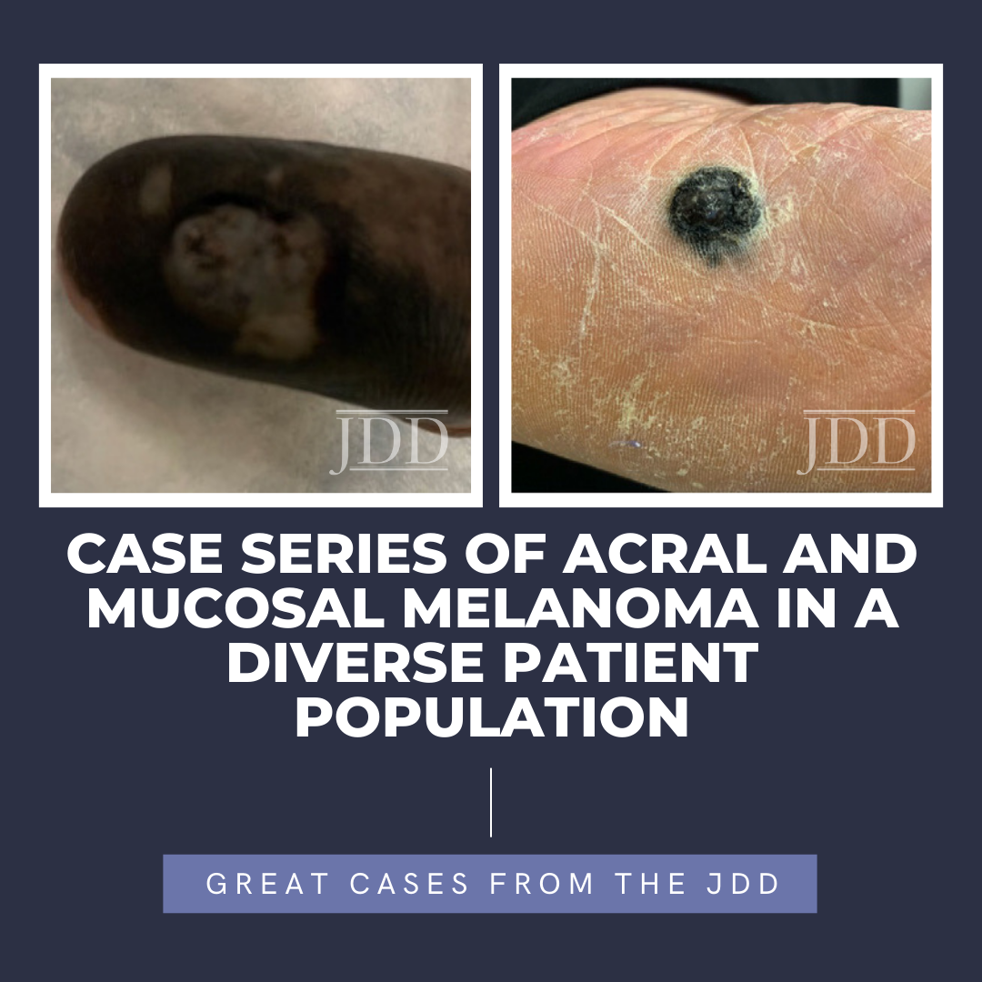 acral melanoma