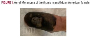 melanoma