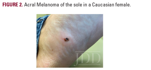 acral melanoma
