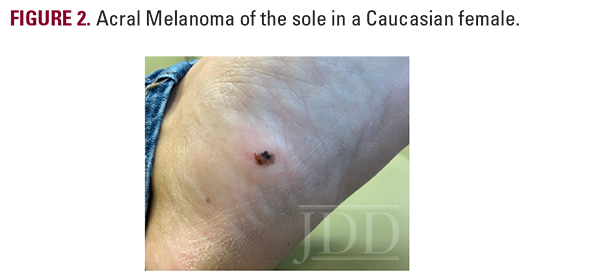 acral melanoma