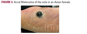 acral melanoma
