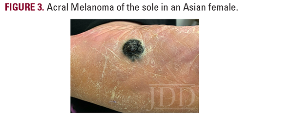 acral melanoma