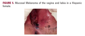 mucosal melanoma