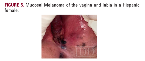 mucosal melanoma