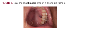 oral mucosal melanoma