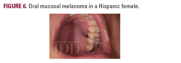 oral mucosal melanoma