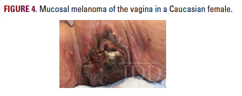 mucosal melanoma