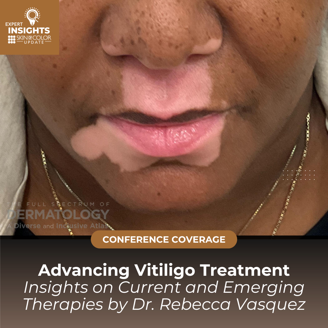 vitiligo patient