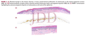 vitiligo