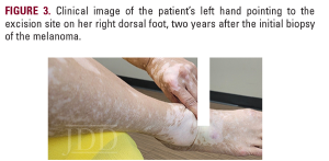 vitiligo