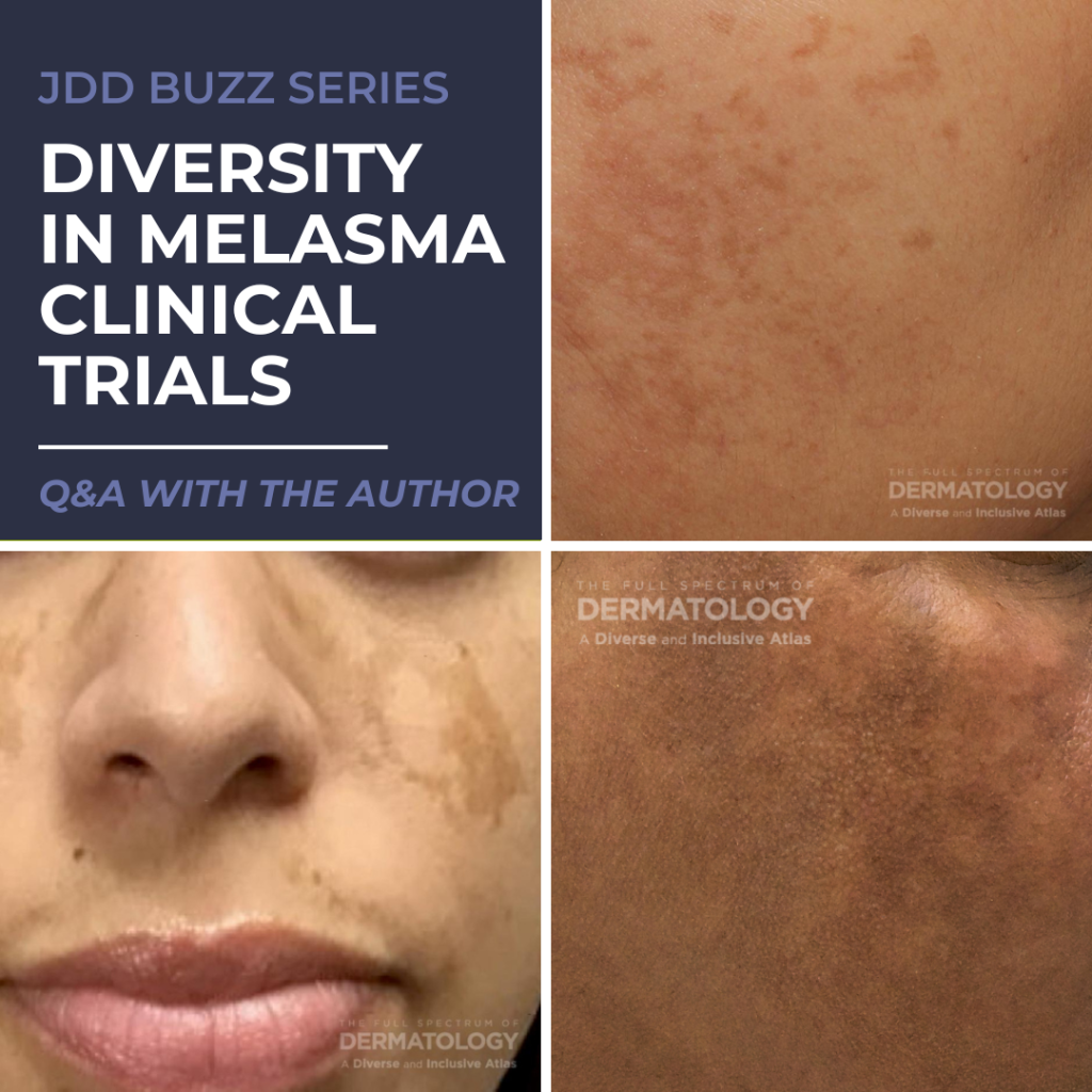 melasma