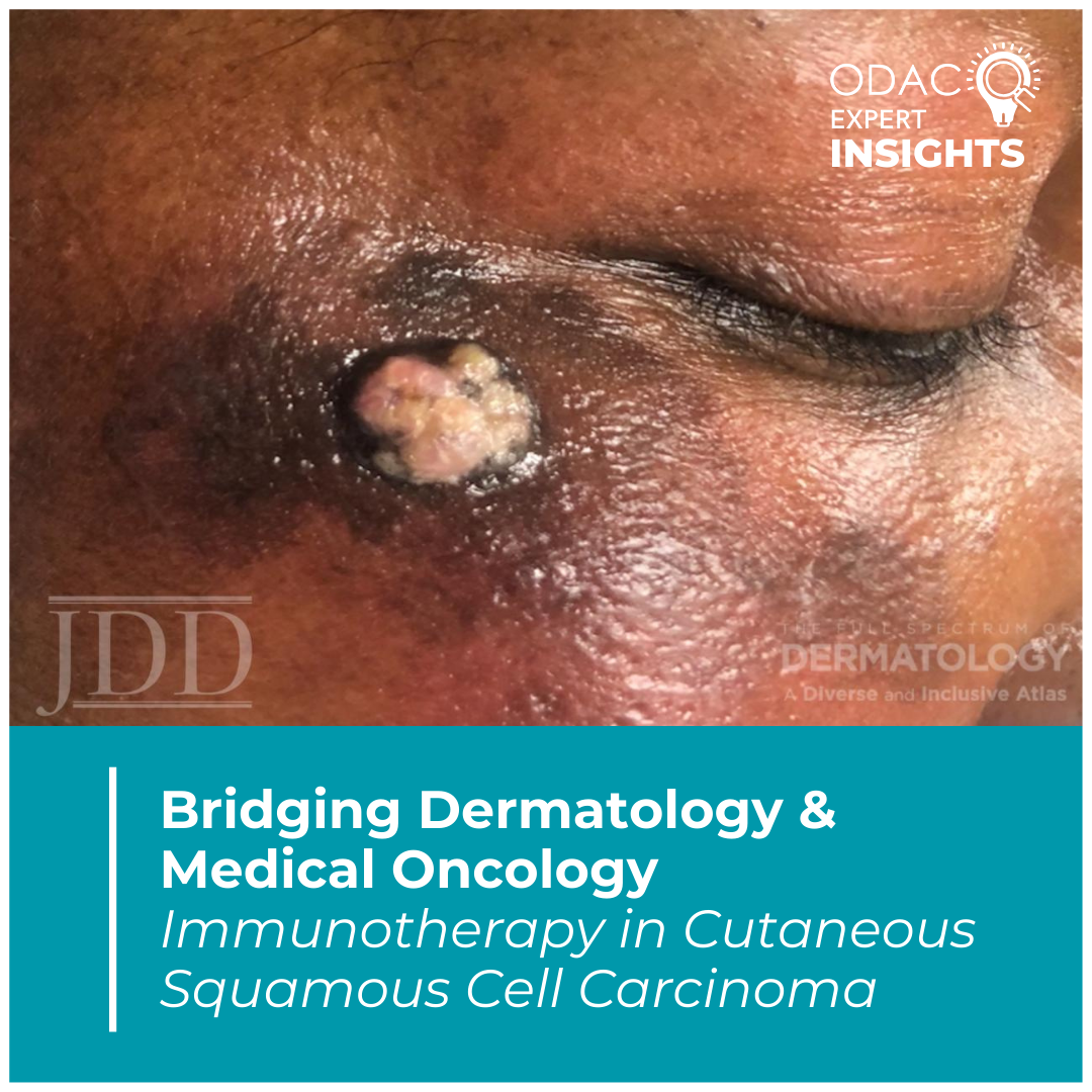 Cutaneous Squamous Cell Carcinoma (cSCC)