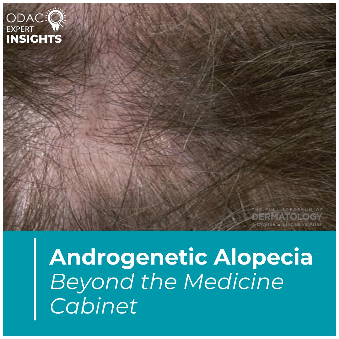 androgenetic alopecia