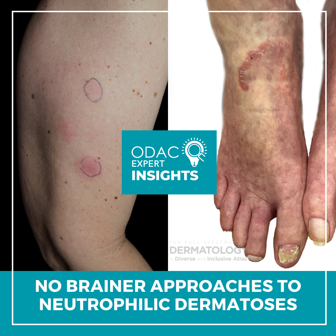 Neutrophilic Dermatoses