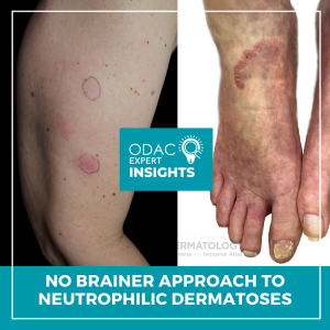 Neutrophilic Dermatoses