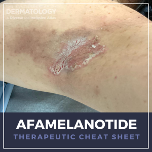Afamelanotide