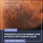 Pseudofolliculitis Barbae (PFB)