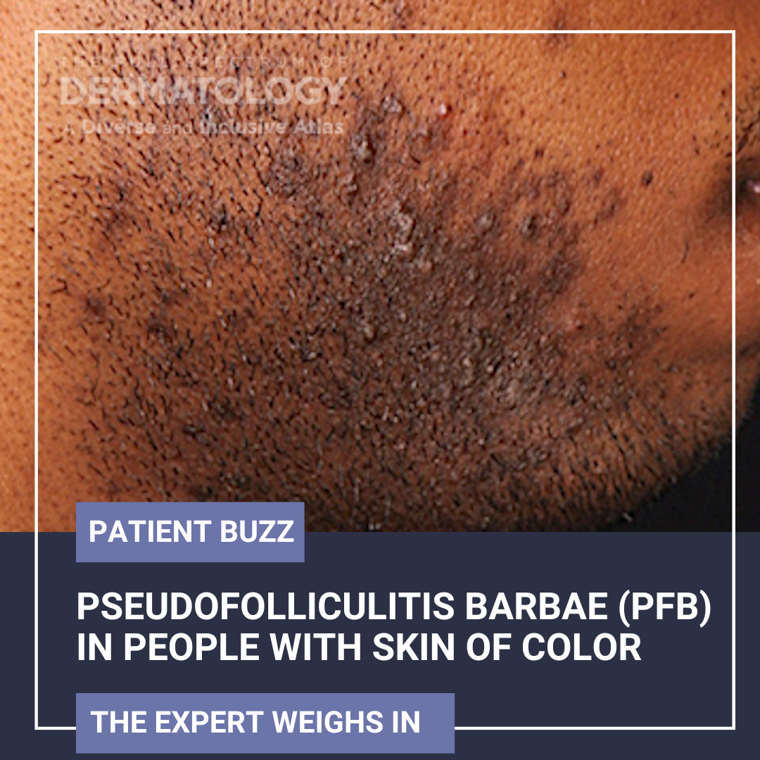 Pseudofolliculitis Barbae (PFB)