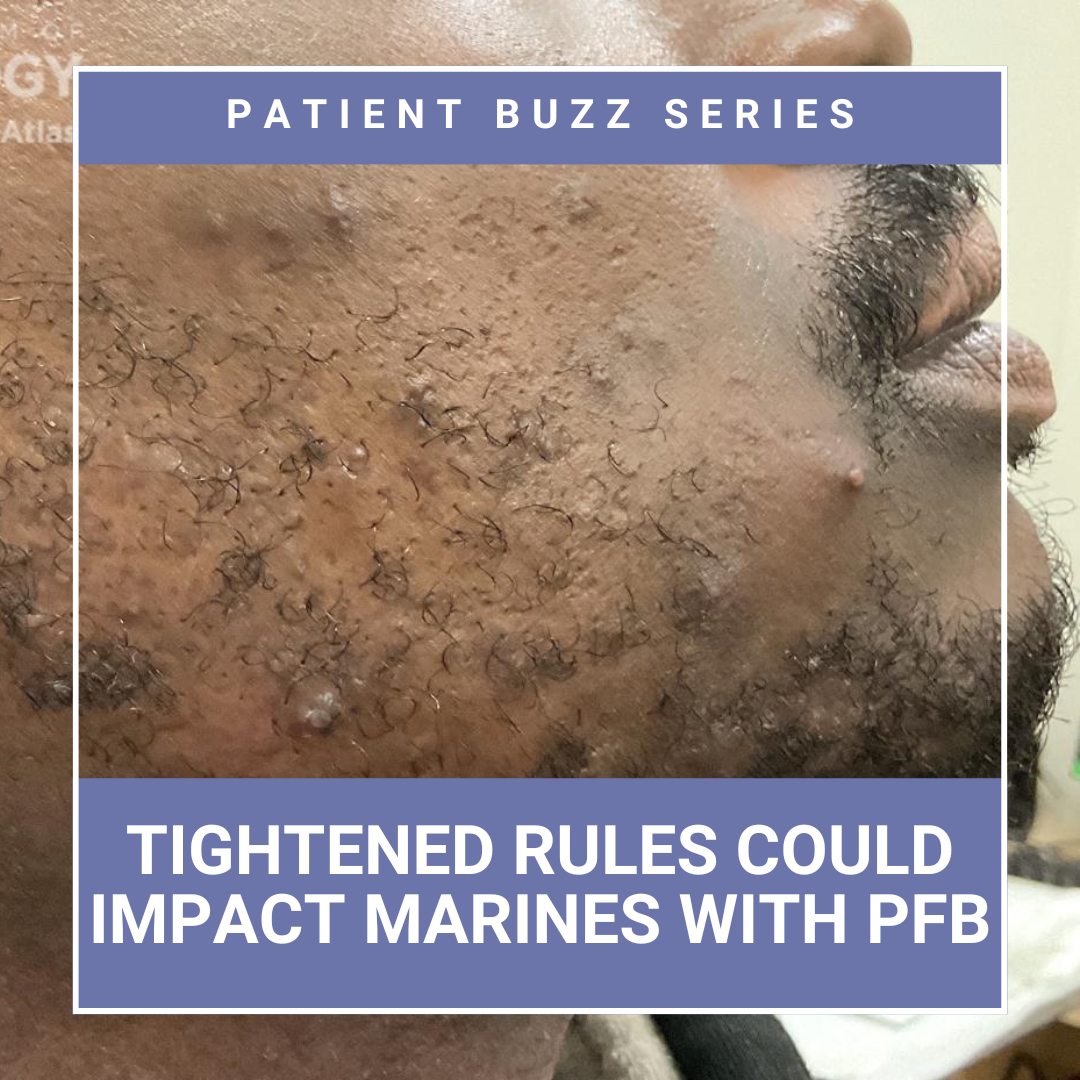 pseudofolliculitis barbae (PFB)