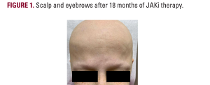 alopecia universalis