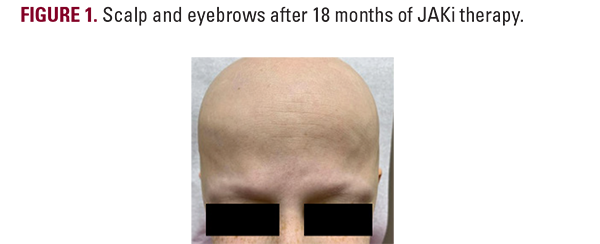alopecia universalis