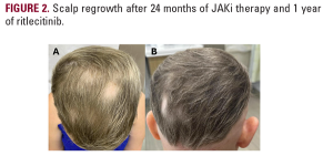 alopecia universalis