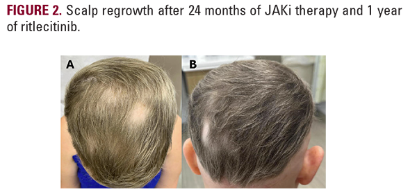 alopecia universalis
